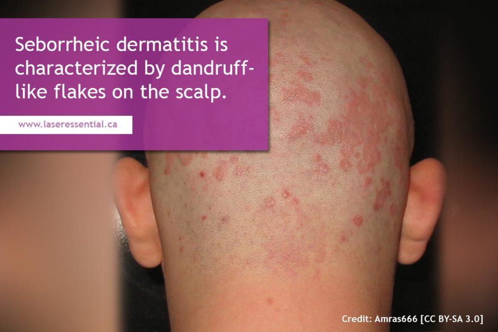 Seborrheic dermatitis is characterized by dandruff-like flakes on the scalp.
