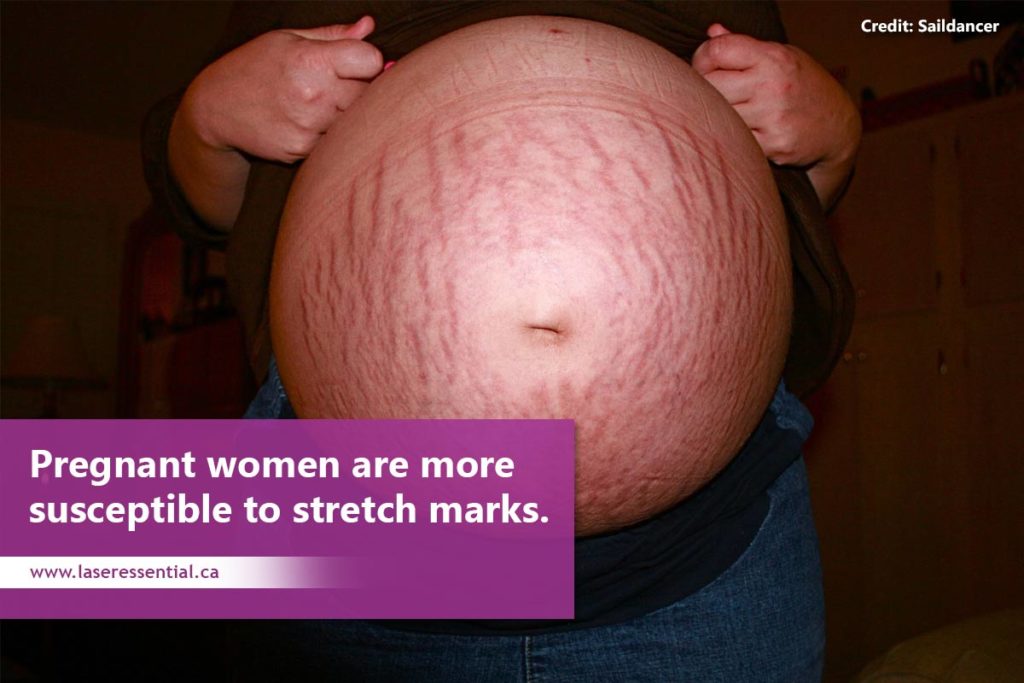 Pregnant-women-are-more-susceptible-to-stretch-marks