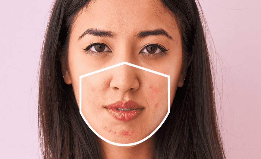 Maskne: the acne underneath - Laser Essential & Skin Care